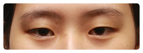 -자연스런 쌍꺼풀이 뭘까??-          [안병준의 눈이야기] 관련 이미지 4