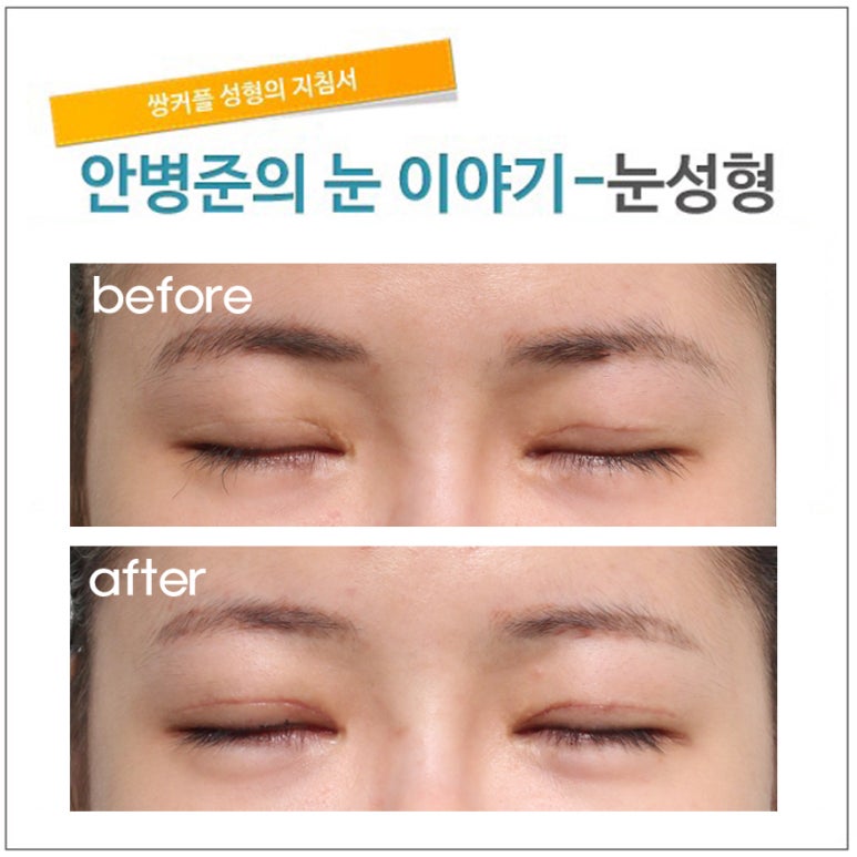 4번째 재수술(쌍꺼풀수술 흉터제거,재수술) 관련 이미지 2