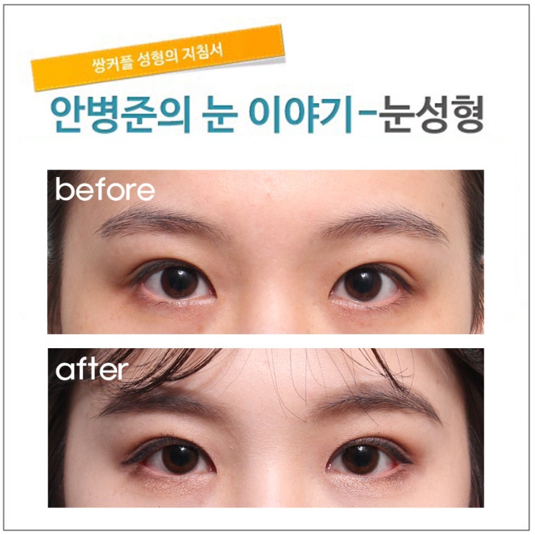 잘 떠지는 눈(자연스러운 쌍꺼풀 수술) 관련 이미지 1