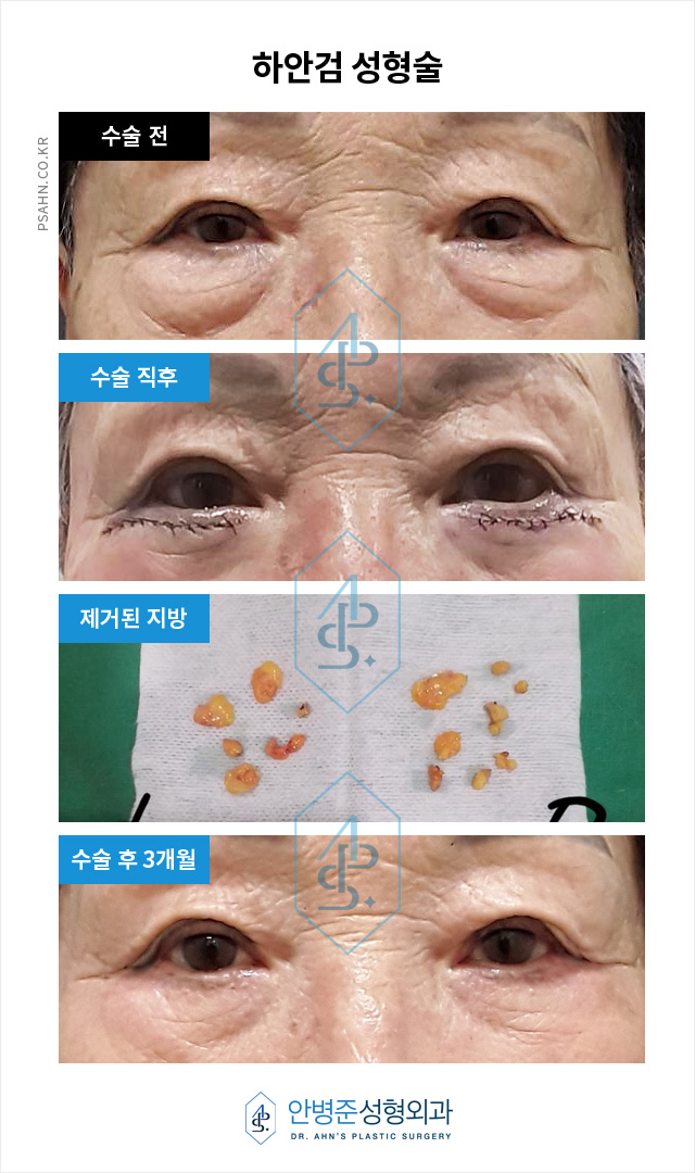눈 밑 처짐,붓기,아래 눈꺼풀 주름 등 - 하안검 성형술 관련 이미지 1