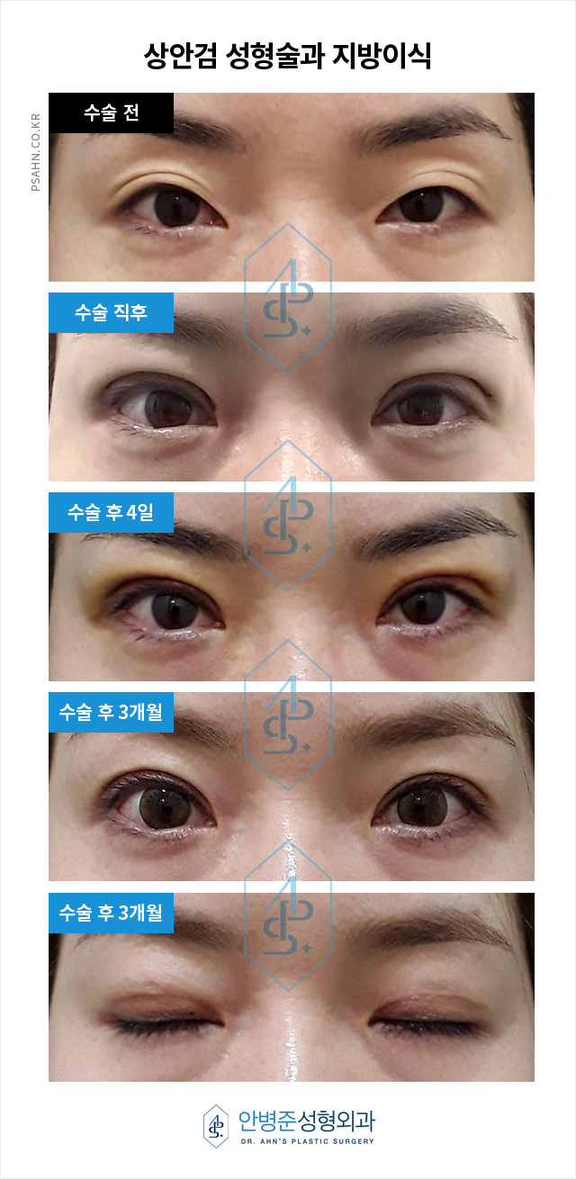 [방배역 안병준성형외과] 상안검성형술과 지방이식 관련 이미지 1