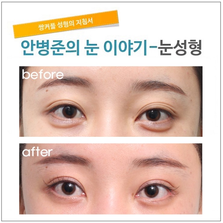 눈매교정으로 꺼진 눈과 겹주름 눈 보완.(눈매교정,꺼진눈수술,꺼진눈) 관련 이미지 1