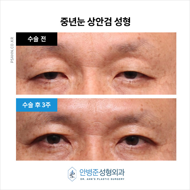 [중년눈성형] 중년 이후 눈 성형, 상안검과 하안검의 역할은? 관련 이미지 2