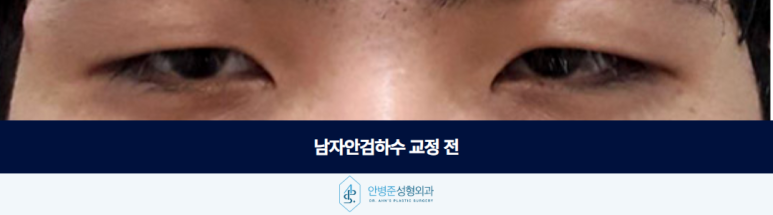 남자안검하수 눈이 처진 것 같다면 확인해야 할 것이 있습니다 관련 이미지 2