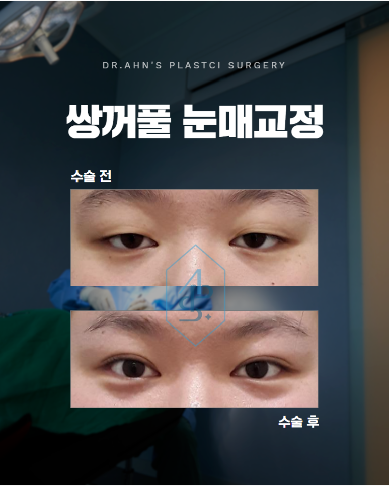 쌍꺼풀 눈매교정 조화롭게 자연스러움과 또렷함을 찾아서 관련 이미지 1