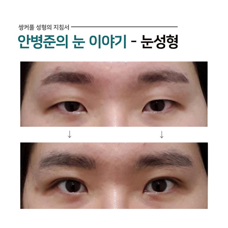 얼굴 비대칭으로 인한 짝눈(비대칭,짝눈,안검하수) 관련 이미지 1