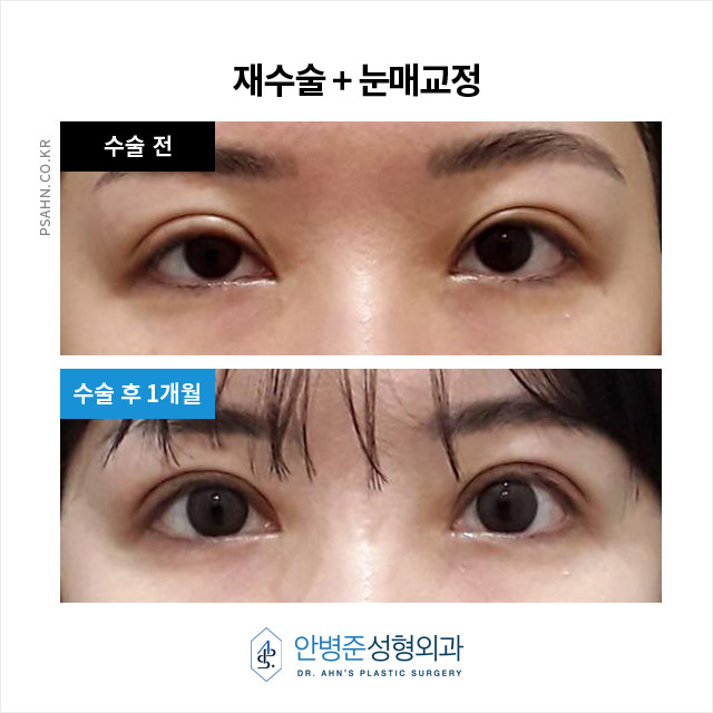 [눈재수술]  두 번의 눈 재수술, 4년간의 관련 이미지 4