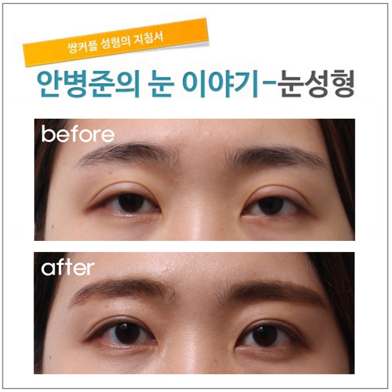 라인이 커서 눈뜨기 불편한 눈(재수술,안검하수,눈매교정) 관련 이미지 1