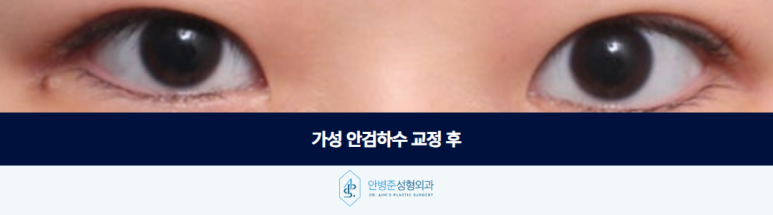 가성 안검하수 잘 구분되지 않지만 수술 방향은 전혀 달라야 합니다 관련 이미지 3