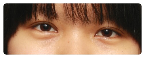 짝짝이눈 쌍꺼풀수술 한달반 경과후 관련 이미지 2
