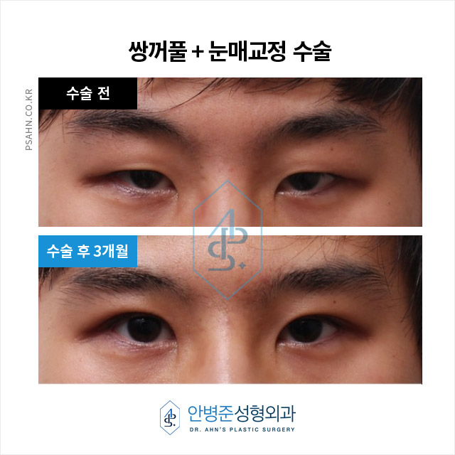 [강남역성형외과] 안검하수와 피부 처짐의 동시 관리 관련 이미지 1