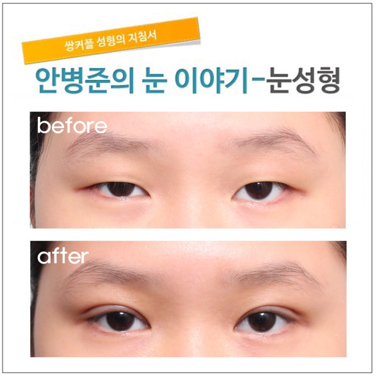 짝눈의 안검하수(짝짝이눈 교정,안검하수) 관련 이미지 1