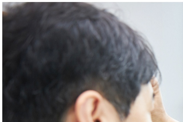 상하안검수술 눈 위아래를 함께 보는 이유 관련 이미지 8