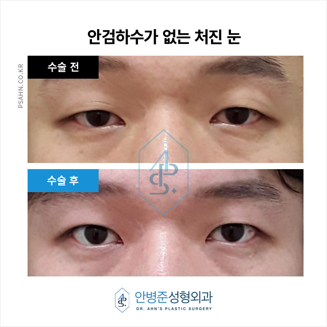 남성 쌍꺼풀 - 자연스러운 이미지 개선과 기능 회복 관련 이미지 3