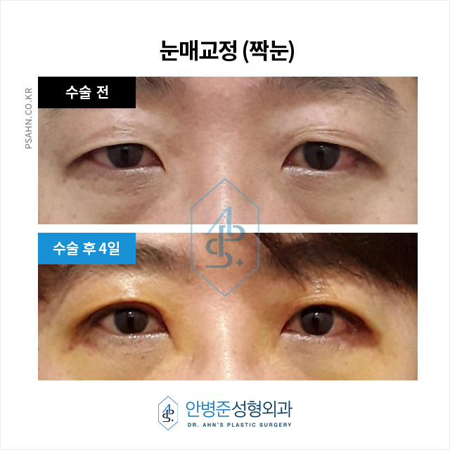 [짝눈성형]남자 짝눈 교정, 단순 쌍수로는 부족한 이유 관련 이미지 2