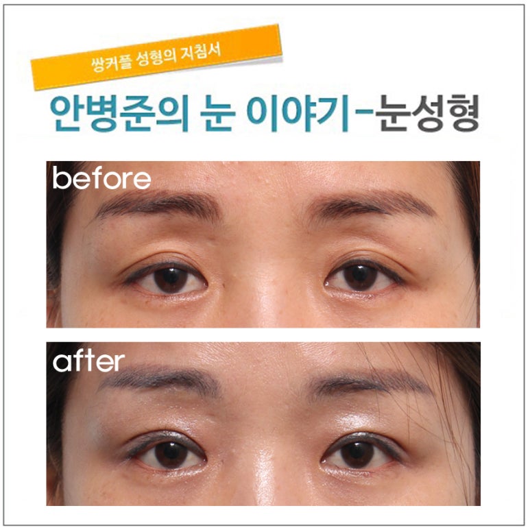 매몰후 안검하수 유발 관련 이미지 1