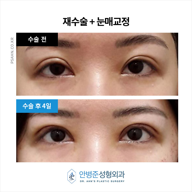 [눈재수술]  두 번의 눈 재수술, 4년간의 관련 이미지 3