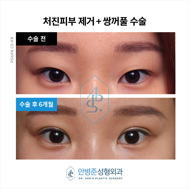 강한 인상? 부드럽게 완화한 눈꼬리 교정 쌍꺼풀 수술 관련 이미지 2