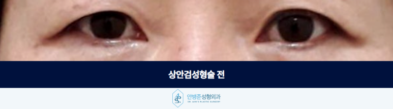 상안검성형술 눈꺼풀 처짐이 심하다면 이것까지 고려해야 합니다 관련 이미지 2
