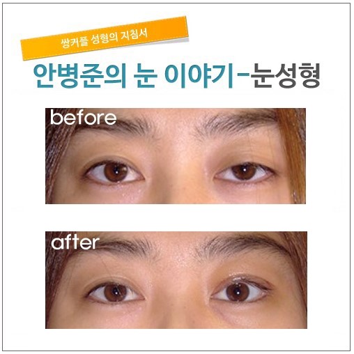 안검하수 또는 눈매교정시 어려운 점. 관련 이미지 2