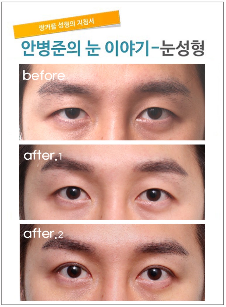 풀린 매몰법에서 두 번의 수술. 관련 이미지 1