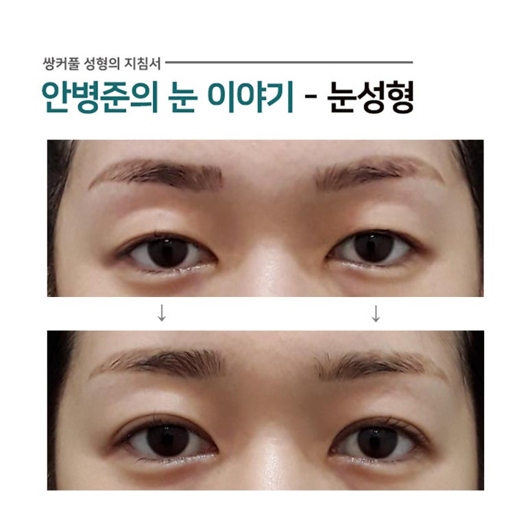 경미한 짝눈,피부처짐(안검하수,눈매교정) 관련 이미지 1