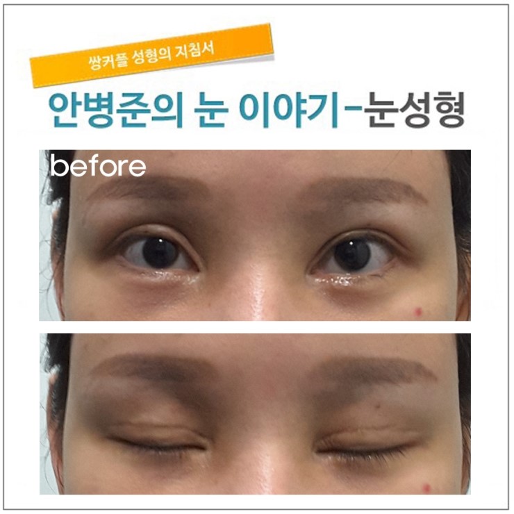 2번의 수술경력(중국환자)재수술 관련 이미지 1