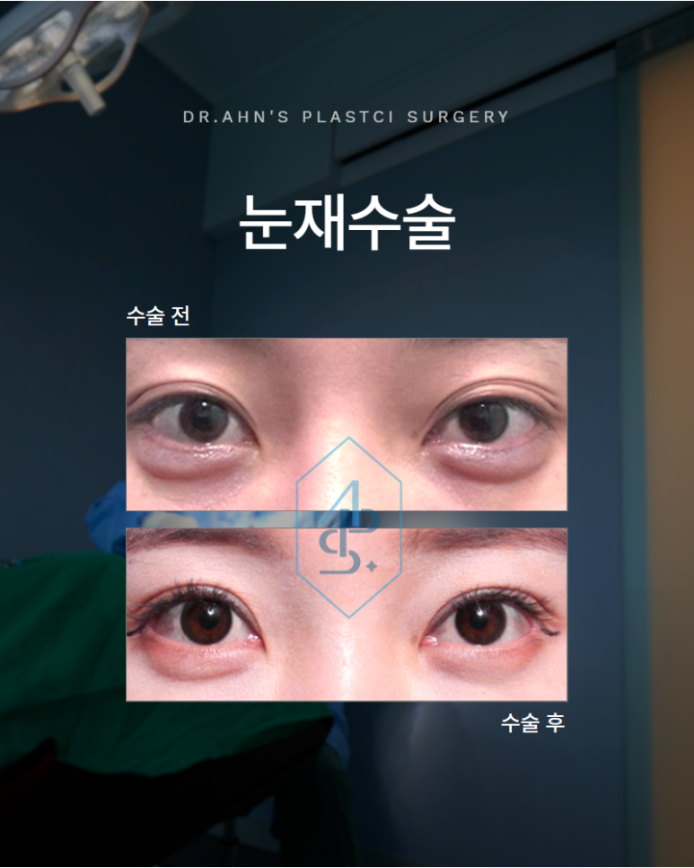 If you want the desired results from double eyelid revision surgery, you have to start over with the design image 1