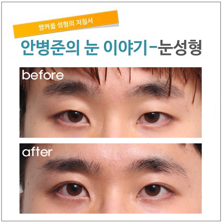 경미한 안검하수 관련 이미지 1