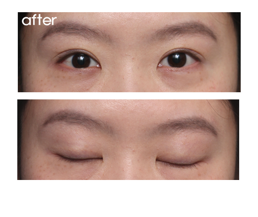 소시지눈을 자연쌍꺼풀처럼 고치기.(소시지눈,소시지눈재수술,쌍꺼풀재수술) 관련 이미지 2