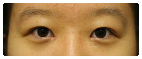 진짜 안검하수와 가짜 안검하수.(안검하수) 관련 이미지 5