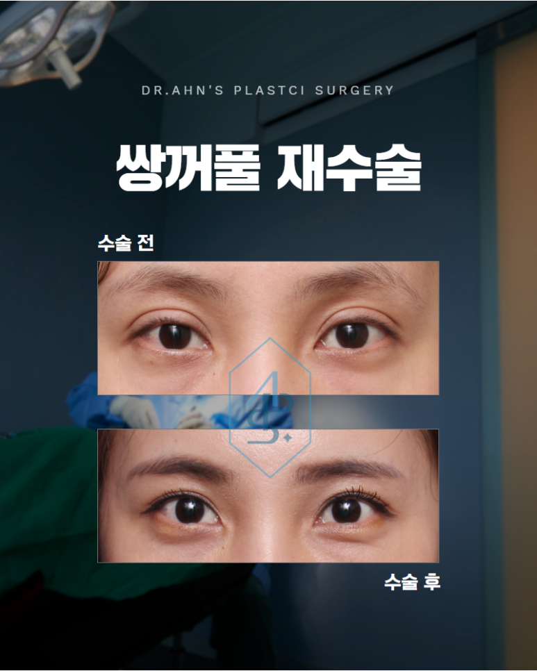쌍꺼풀재수술 절개법을 이용하여 자연스러운 눈매를 찾다 관련 이미지 1