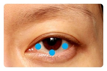 삼백안이란? 원인과 교정 관련 이미지 2