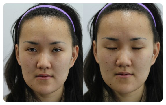 -붓기야? 소시지야?-                 [안병준의 눈이야기] 관련 이미지 1