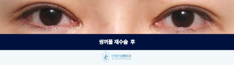 쌍꺼풀 재수술 잘하는병원 여러 번 수술한 눈일수록 이것이 필요합니다 관련 이미지 3