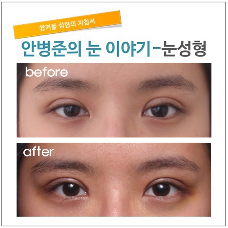 첫수술의 중요성 [재건]-완성편. 관련 이미지 4