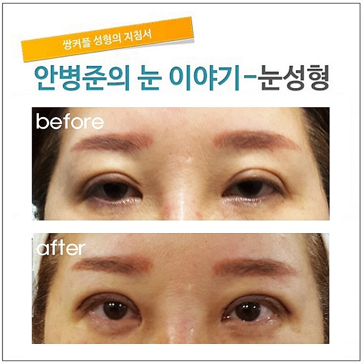 pretarsal fullness ( 일명 소세지)소시지눈,소시지눈고치기 관련 이미지 1