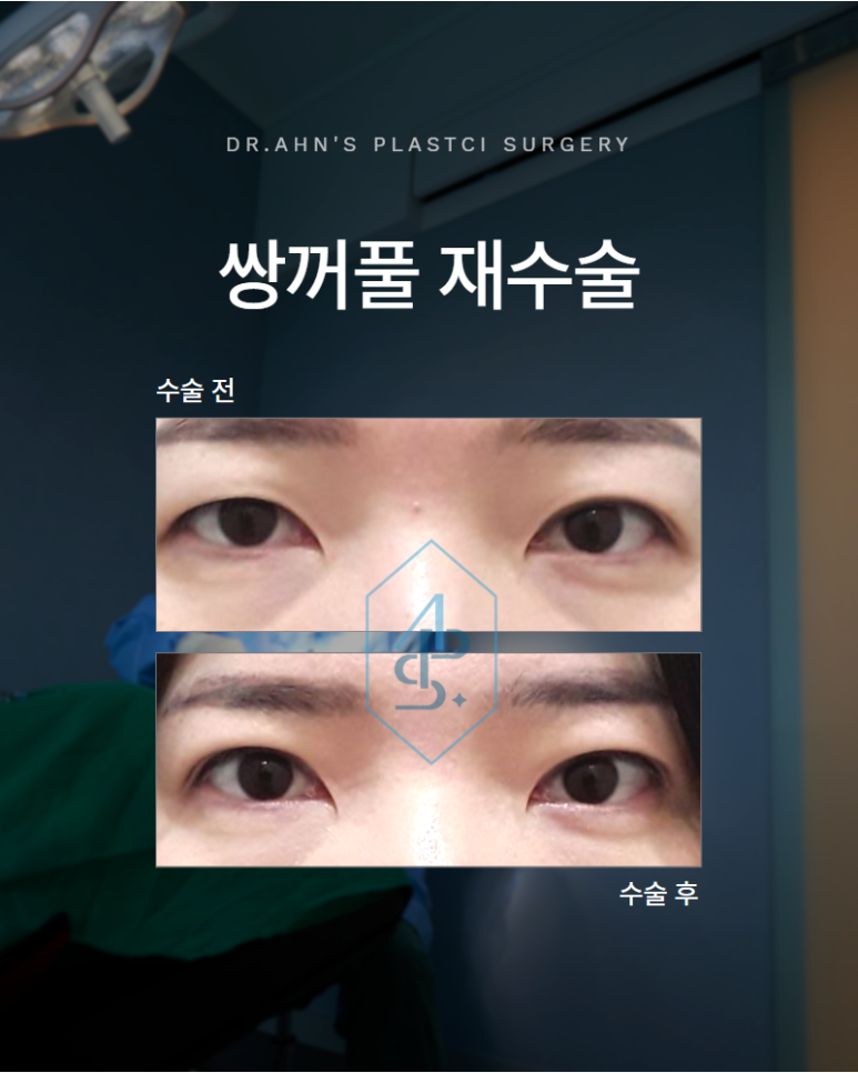 쌍꺼풀 재수술 가짜 안검하수 눈매교정이 필요 없는 눈은 어떻게 구분할까 관련 이미지 1