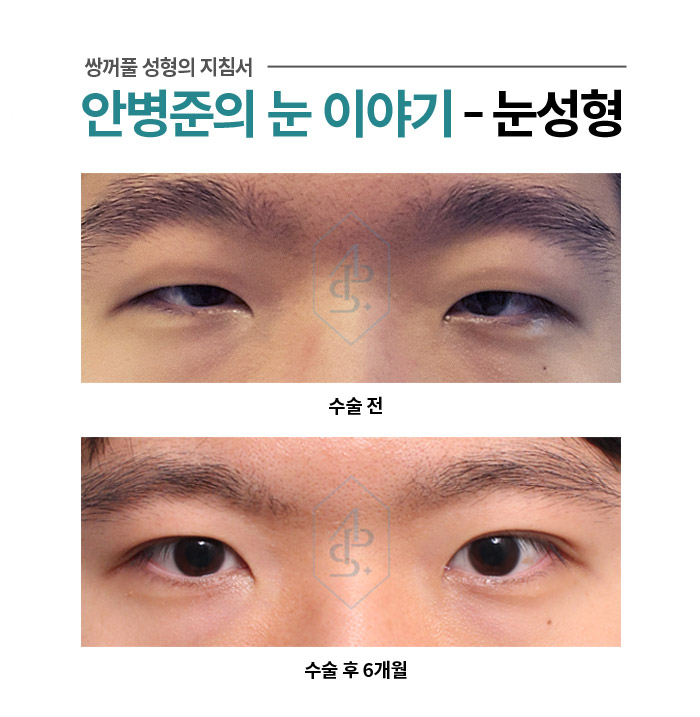 안검하수가 심한 경우 남자 눈성형 - 쌍꺼풀 눈매교정 관련 이미지 1