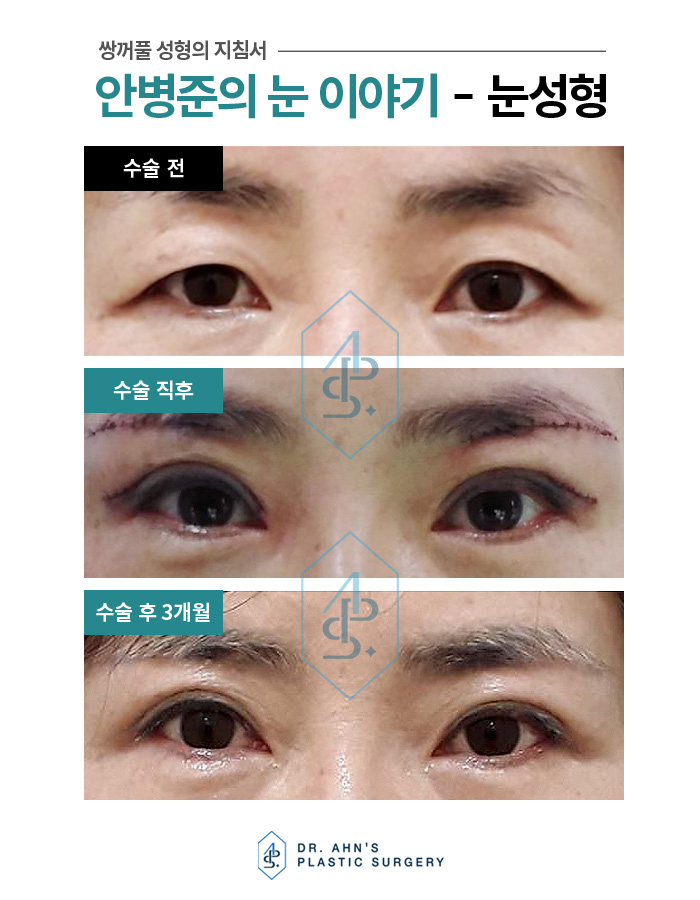 상안검성형술만으로 부족하시면 눈썹밑 절개와 같이? 관련 이미지 3