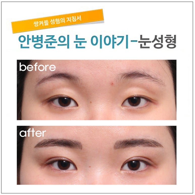 안검하수와 꺼진눈(쌍꺼풀수술,눈매교정,지방이식) 관련 이미지 1