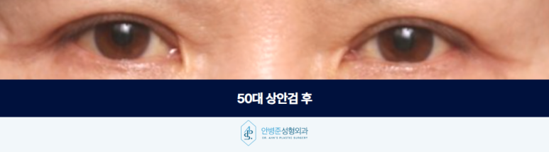 50대 상안검 나이들수록 처진 눈꺼풀이 콤플렉스로 다가온다면 관련 이미지 3