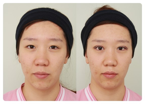 -쌍꺼풀 수술은 왜 하려하는가??-        [안병준의 눈이야기] 관련 이미지 1