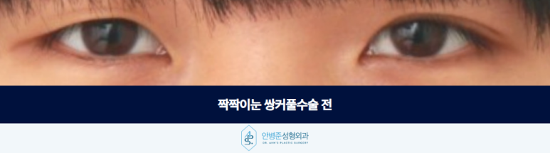쌍커풀수술 짝짝이눈 고민될때 짚어봐야 할 점은 관련 이미지 2