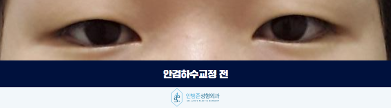 안검하수교정 눈이 항상 무겁고 피곤해 보인다면 관련 이미지 2