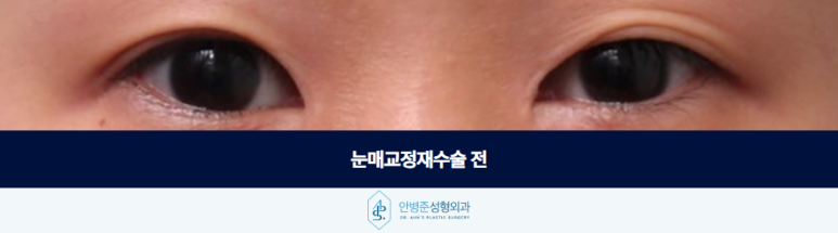 눈매교정재수술 라인이 풀리고 졸려 보인다면 확인해야 할 것은 관련 이미지 2