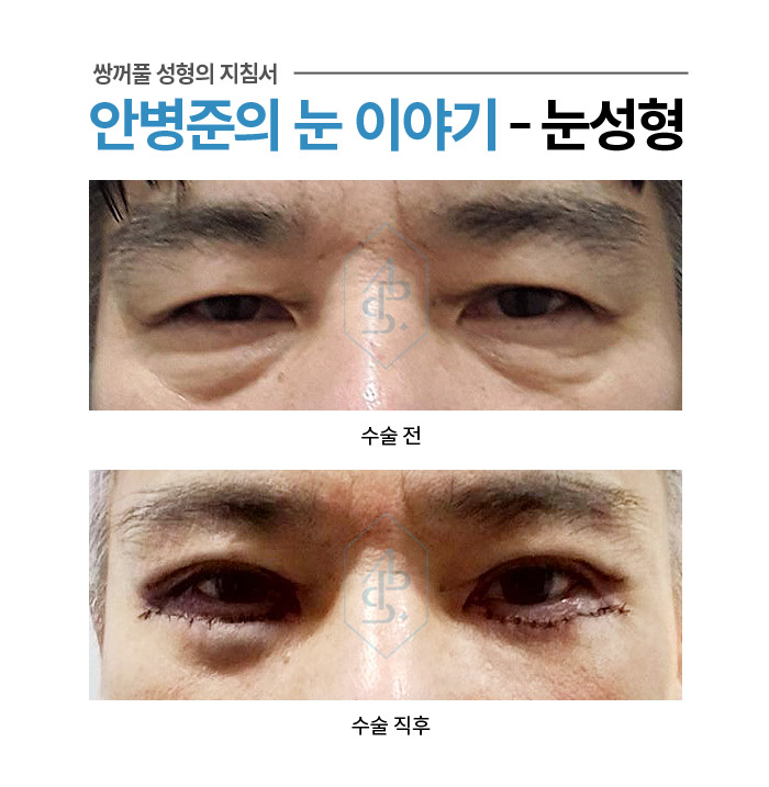 쌍꺼풀 수술에서 부기란? - 수술직후 붓기 사례 모음 관련 이미지 7