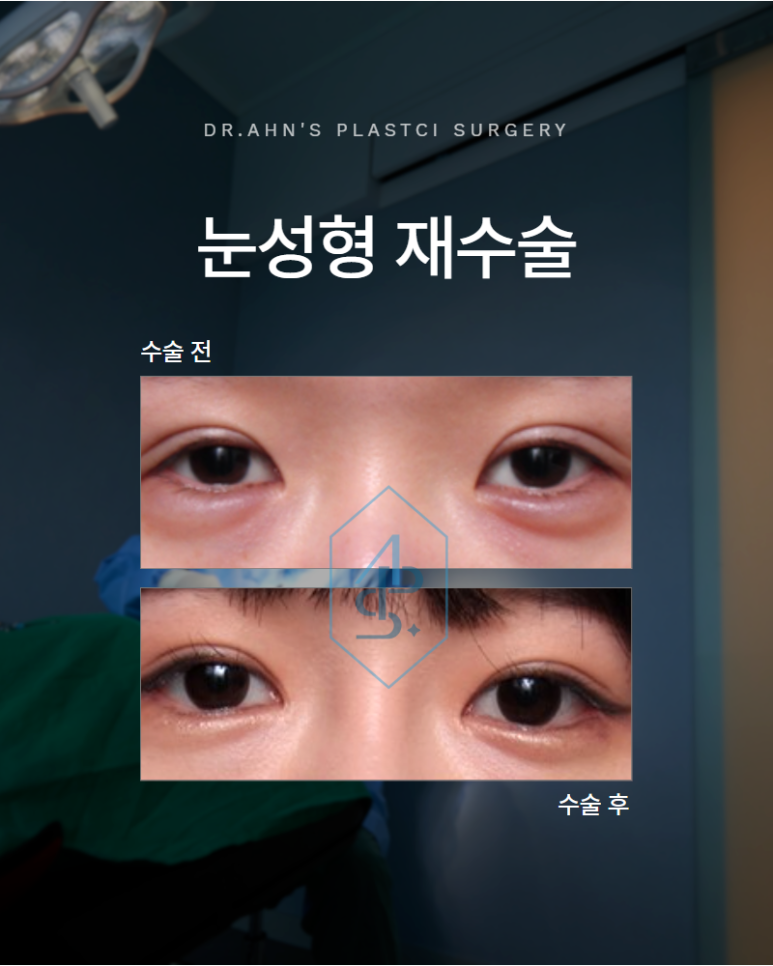 What You Should Check Before Rushing to a Ptosis Diagnosis in Revision Eye Surgery image 1