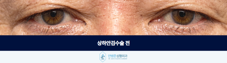 상하안검수술 눈 위아래를 함께 보는 이유 관련 이미지 3
