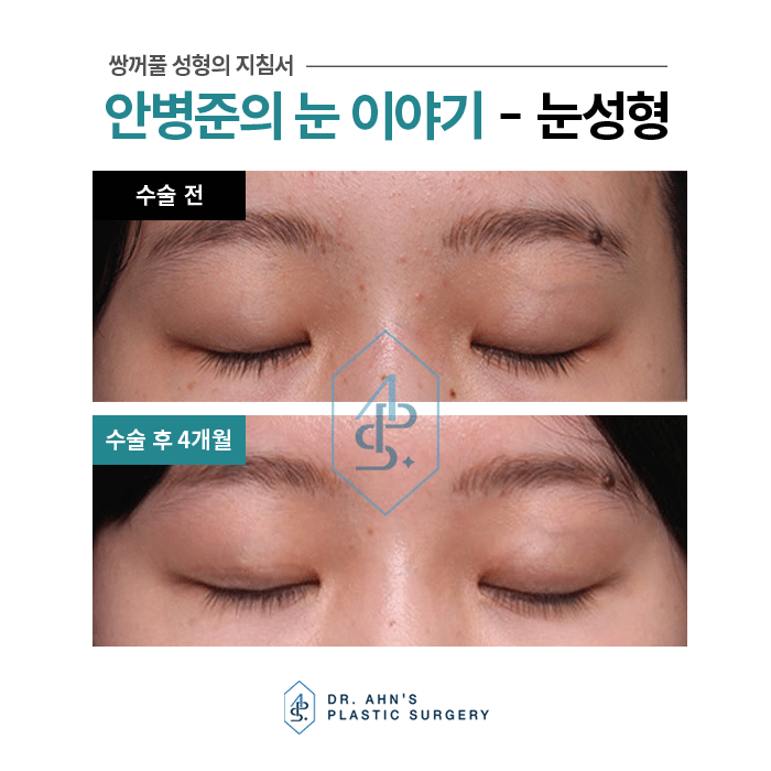 [안검하수성형외과] 잘못 알고 있는 가짜 안검하수 관련 이미지 3
